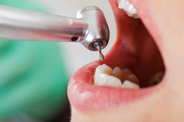 Best Emergency Treatment for Dental Infections or Abscesses in Blaine, MN